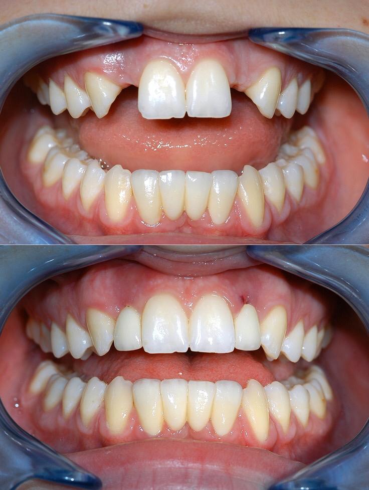 implant